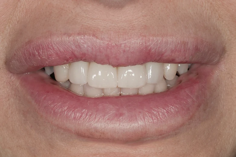 Dopo faccette denti