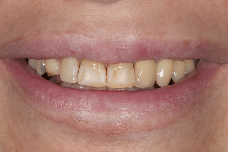 Prima faccette denti