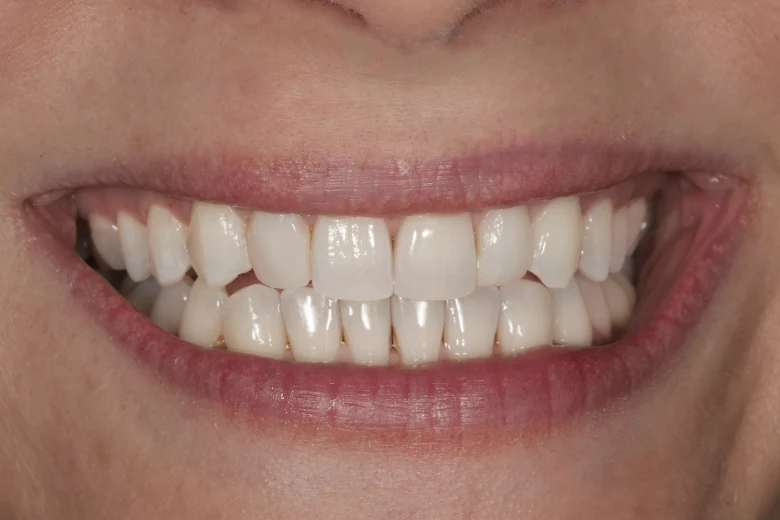 Dopo sbiancamento denti