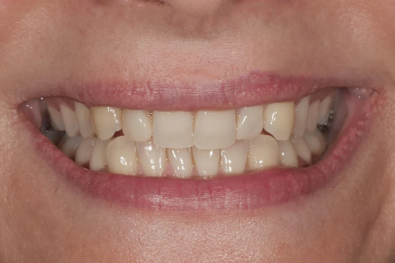 Prima sbiancamento denti