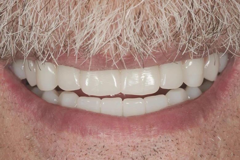 Dopo implantologia denti