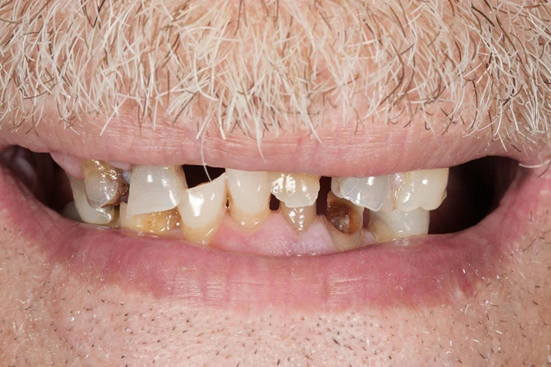 Prima implantologia denti