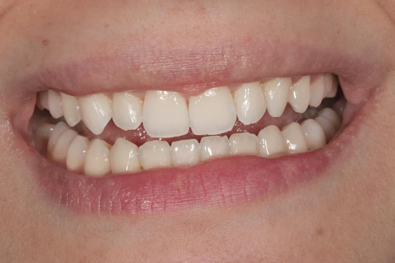 Dopo sbiancamento denti