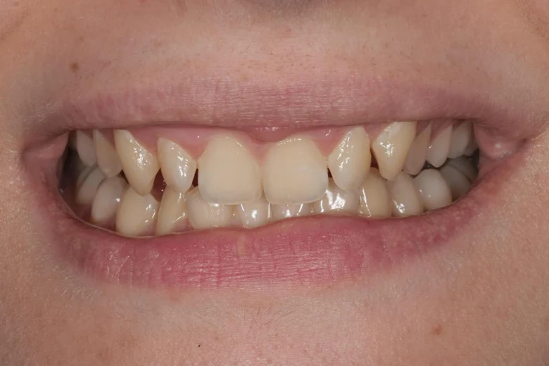 Prima sbiancamento denti