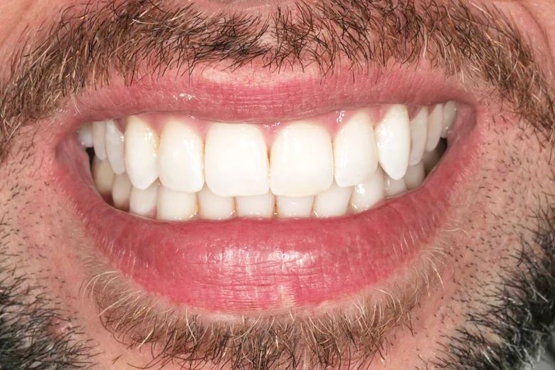 Dopo sbiancamento denti