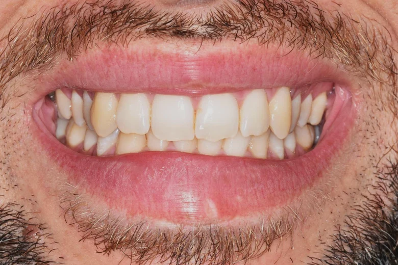 Prima sbiancamento denti
