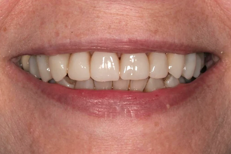 Dopo faccette denti