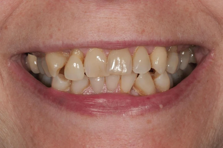 Prima faccette denti