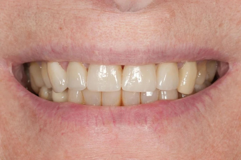 Dopo faccette denti