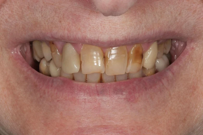 Prima faccette denti