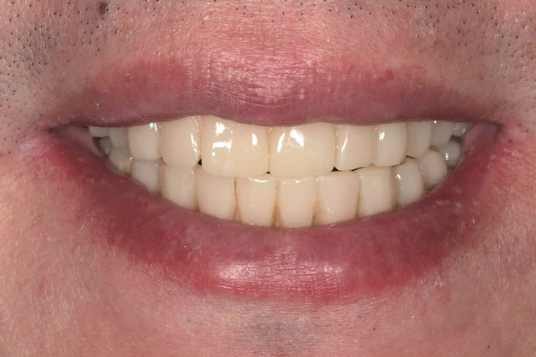 Dopo implantologia denti