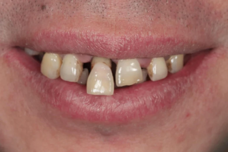 Prima implantologia denti