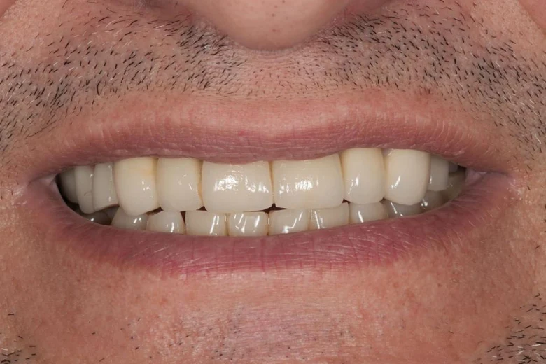 Dopo implantologia denti