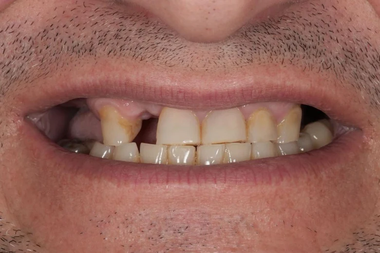 Prima implantologia denti