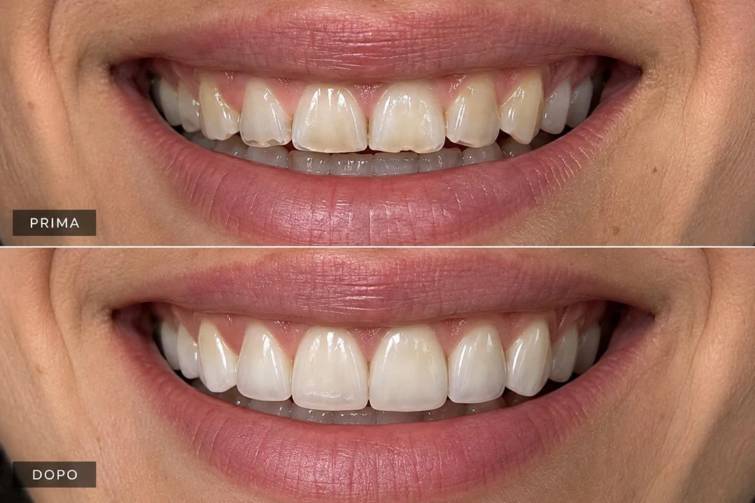 Prima e dopo l'Injection Technique