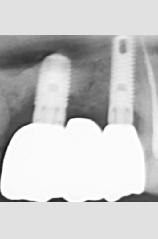 Ponte su due impianti con corone avvitate