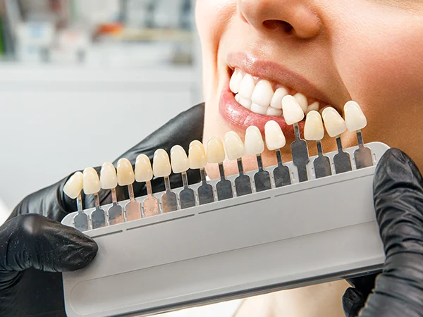 Sbiancamento dentale domiciliare professionale